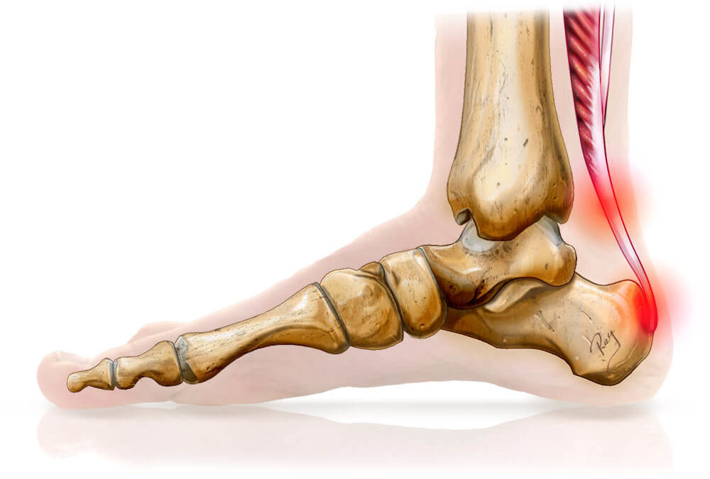 Les douleurs du tendon d’Achille et la course à pied