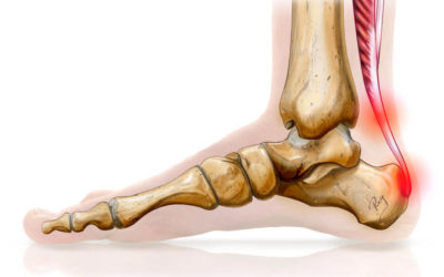 Les douleurs du tendon d’Achille et la course à pied