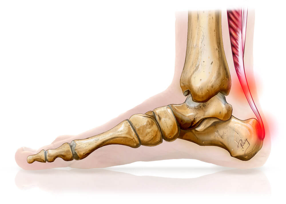 Les douleurs du tendon d'Achille et la course à pied - Promove Santé